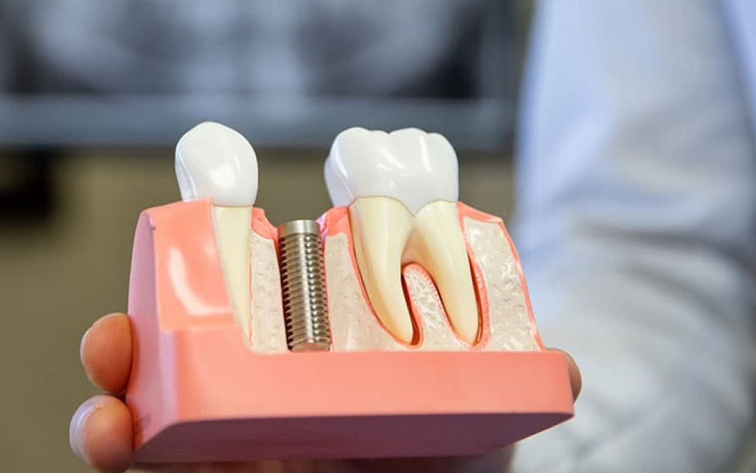 dental implant model