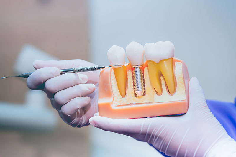 dental implant model