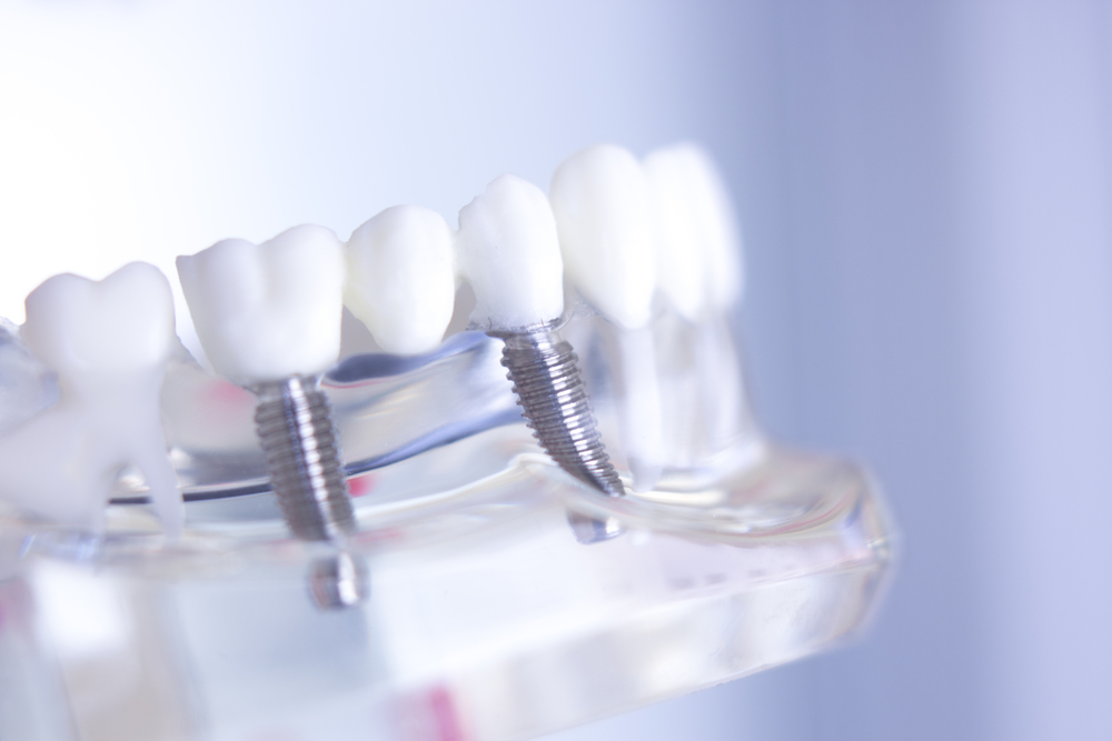 Understanding Your Teeth Implants Financing Options